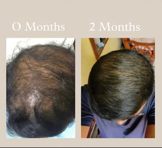 Adivasi Neelgiri Herbal Hair Oil -Buy 1 Get 1 Free🎁